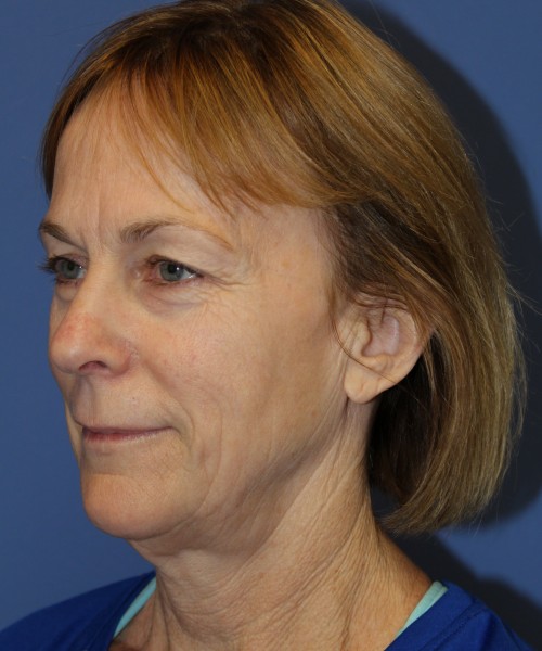 Facelift 1231 – Click HERE for more views before photo. Individual results may vary.