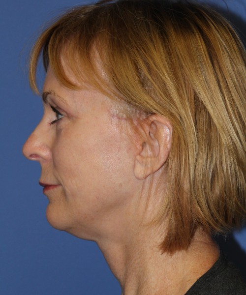 Facelift 1231 – Click HERE for more views after photo. Individual results may vary.