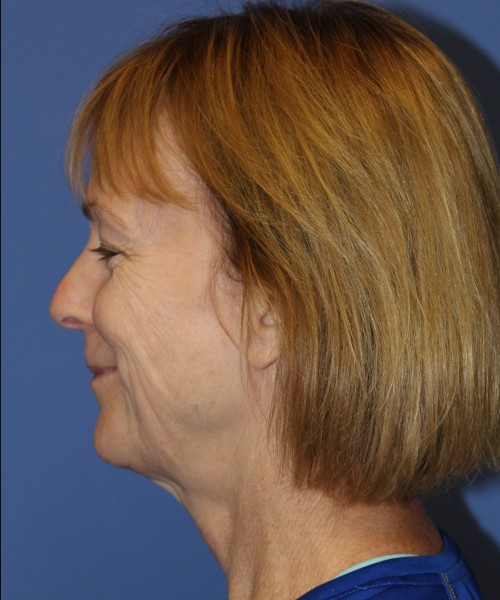 Facelift 1231 – Click HERE for more views before photo. Individual results may vary.