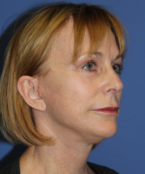 Facelift 1231 – Click HERE for more views after photo. Individual results may vary.