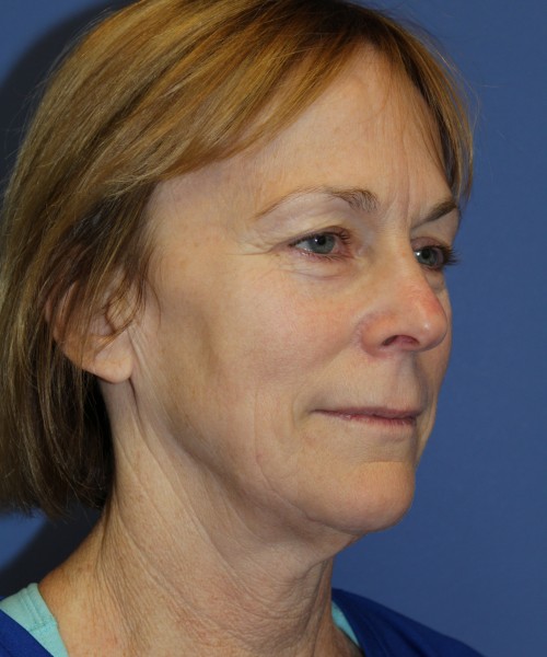 Facelift 1231 – Click HERE for more views before photo. Individual results may vary.