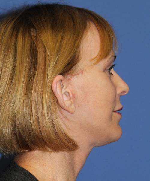 Facelift 1231 – Click HERE for more views after photo. Individual results may vary.