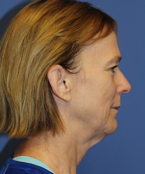 Facelift 1231 – Click HERE for more views before photo. Individual results may vary.