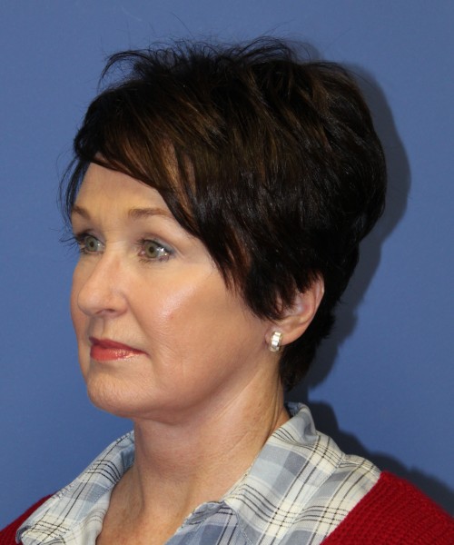 Facelift 1232 – Click HERE for more views after photo. Individual results may vary.