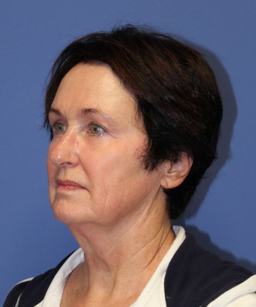 Facelift 1232 – Click HERE for more views before photo. Individual results may vary.