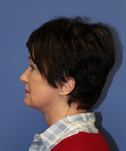 Facelift 1232 – Click HERE for more views after photo. Individual results may vary.