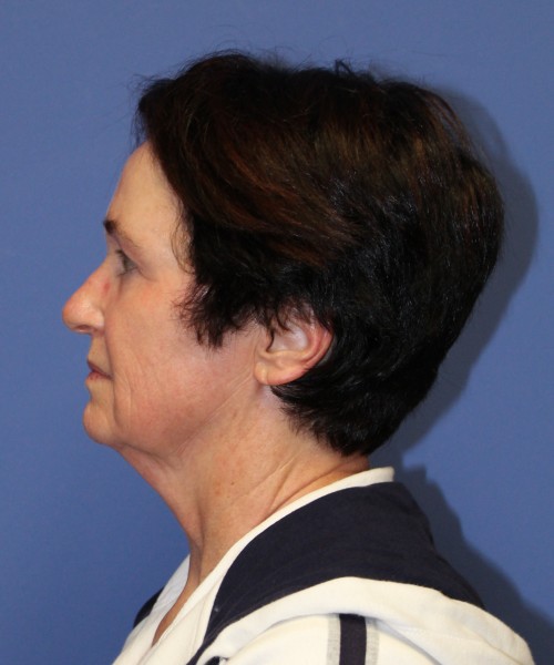 Facelift 1232 – Click HERE for more views before photo. Individual results may vary.
