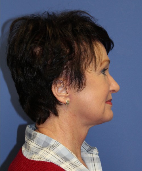 Facelift 1232 – Click HERE for more views after photo. Individual results may vary.