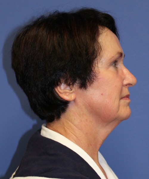Facelift 1232 – Click HERE for more views before photo. Individual results may vary.