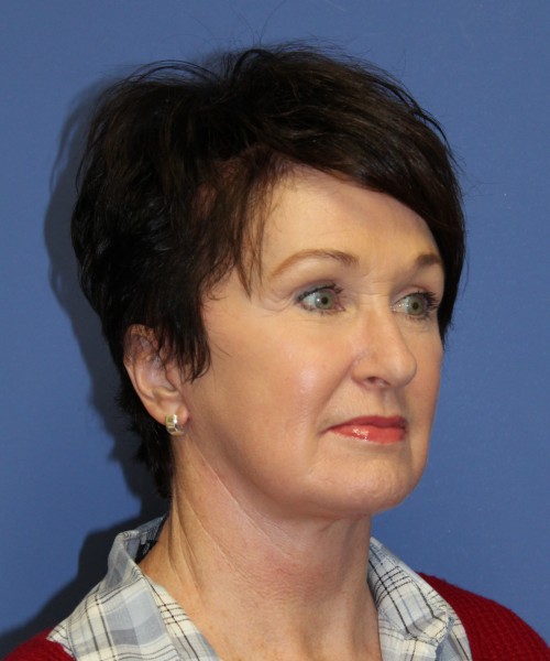 Facelift 1232 – Click HERE for more views after photo. Individual results may vary.