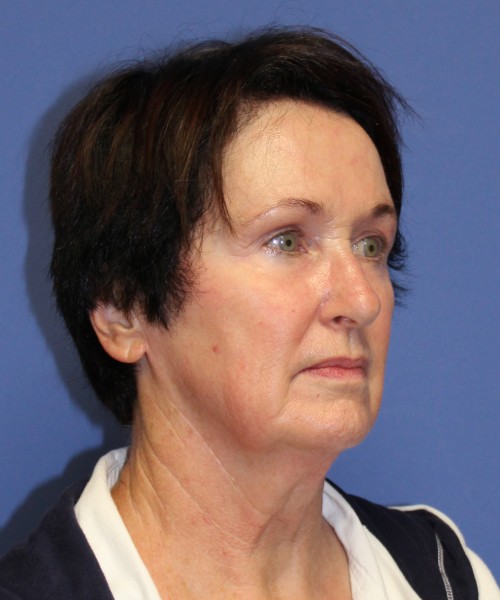 Facelift 1232 – Click HERE for more views before photo. Individual results may vary.