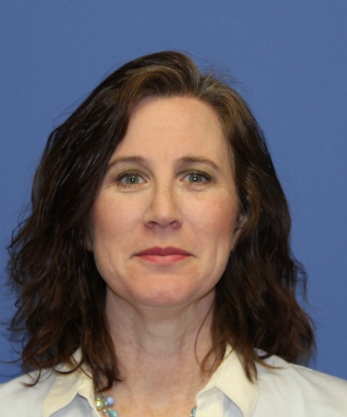 Rhinoplasty 1265 – Click HERE for more views after photo. Individual results may vary.