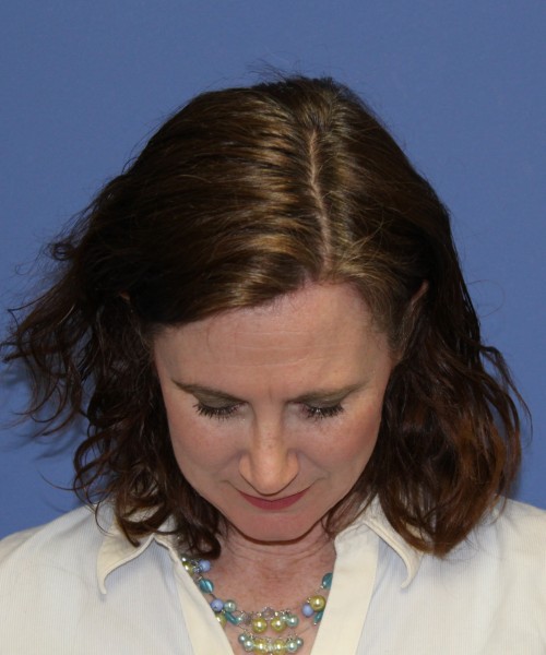 Rhinoplasty 1265 – Click HERE for more views after photo. Individual results may vary.