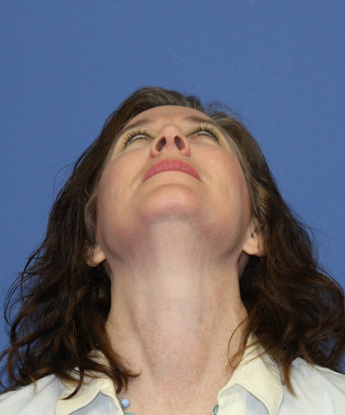 Rhinoplasty 1265 – Click HERE for more views after photo. Individual results may vary.