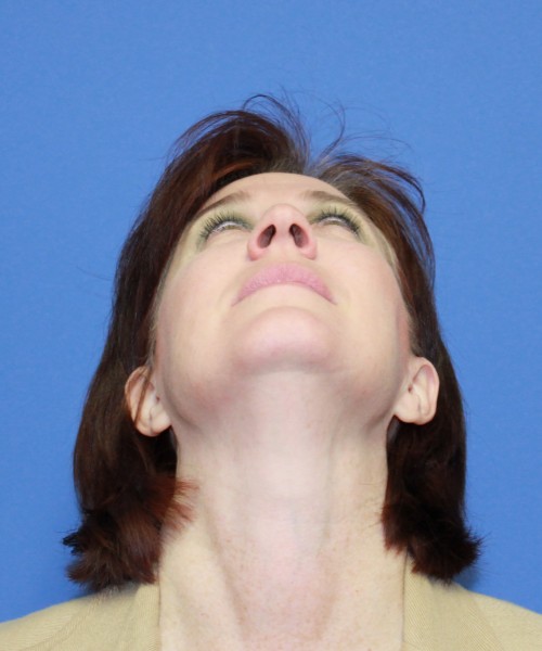 Rhinoplasty 1265 – Click HERE for more views before photo. Individual results may vary.