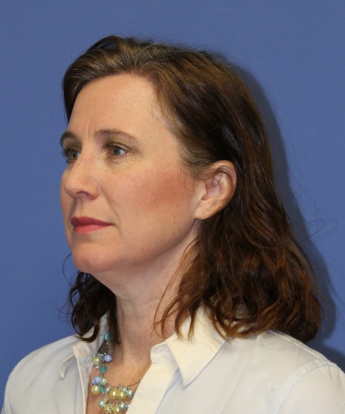 Rhinoplasty 1265 – Click HERE for more views after photo. Individual results may vary.