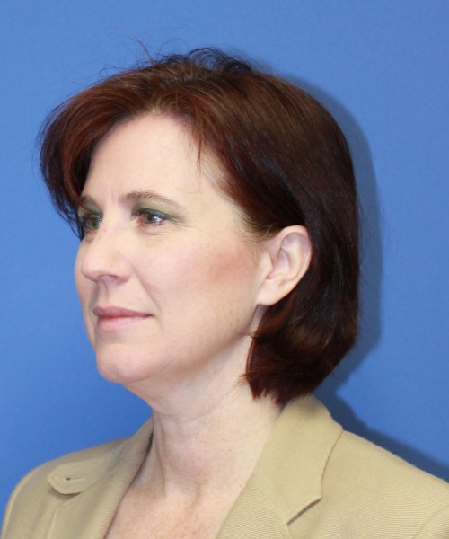 Rhinoplasty 1265 – Click HERE for more views before photo. Individual results may vary.