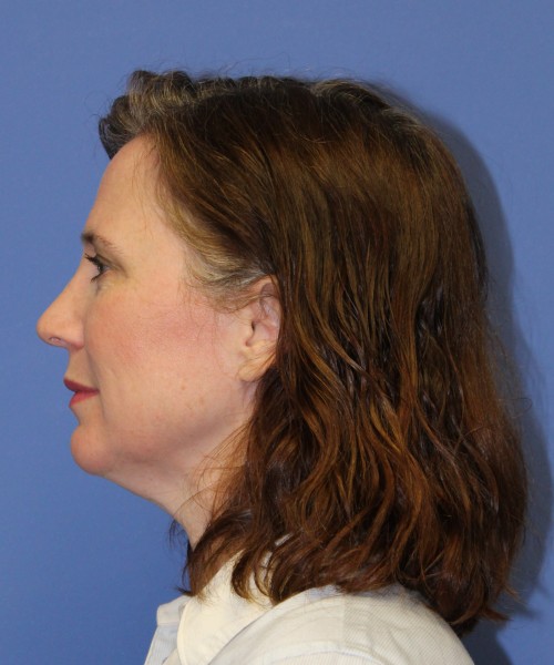 Rhinoplasty 1265 – Click HERE for more views after photo. Individual results may vary.