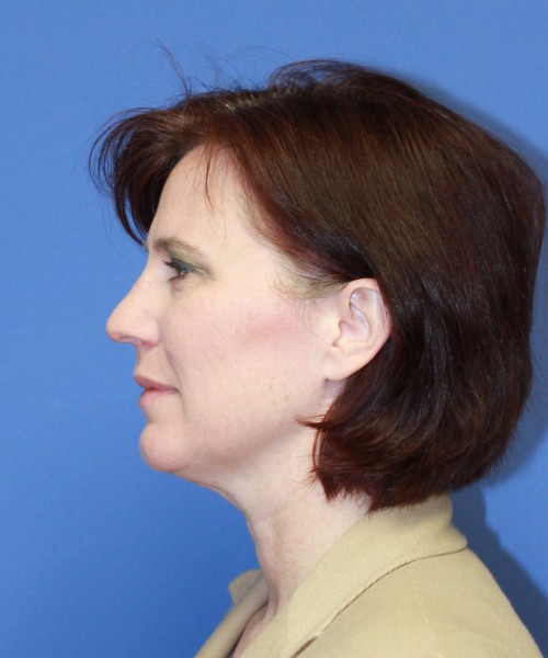 Rhinoplasty 1265 – Click HERE for more views before photo. Individual results may vary.