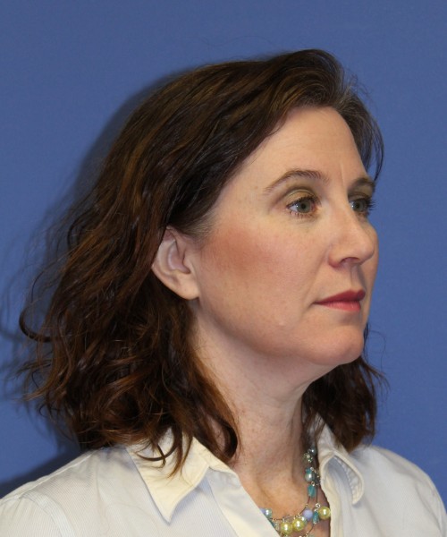 Rhinoplasty 1265 – Click HERE for more views after photo. Individual results may vary.