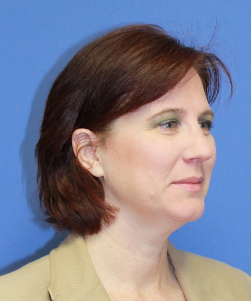 Rhinoplasty 1265 – Click HERE for more views before photo. Individual results may vary.