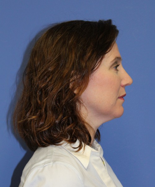 Rhinoplasty 1265 – Click HERE for more views after photo. Individual results may vary.