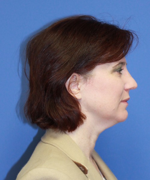 Rhinoplasty 1265 – Click HERE for more views before photo. Individual results may vary.