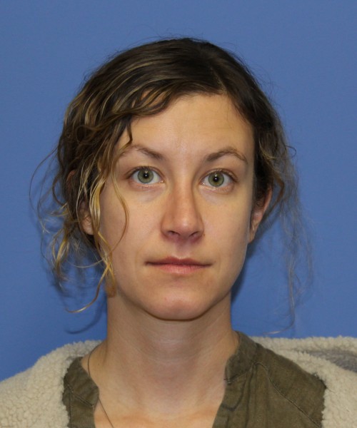 Rhinoplasty 1266 – Click HERE for more views after photo. Individual results may vary.