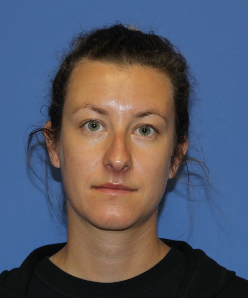 Rhinoplasty 1266 – Click HERE for more views before photo. Individual results may vary.