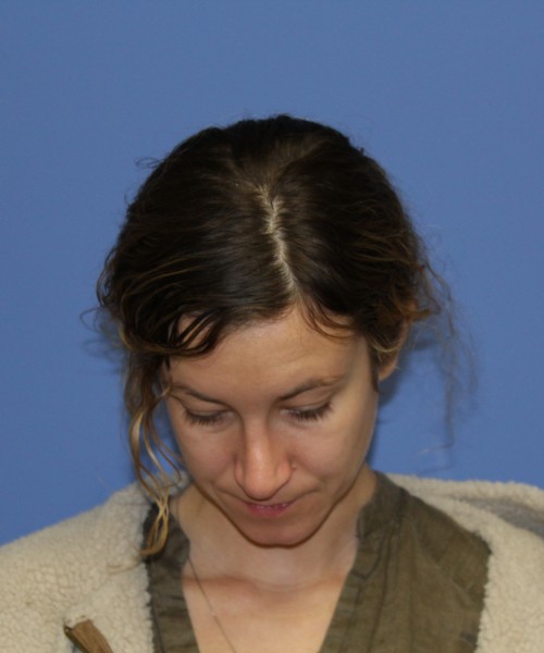 Rhinoplasty 1266 – Click HERE for more views after photo. Individual results may vary.