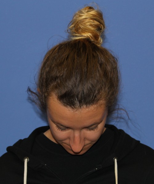 Rhinoplasty 1266 – Click HERE for more views before photo. Individual results may vary.