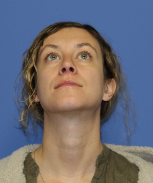 Rhinoplasty 1266 – Click HERE for more views after photo. Individual results may vary.