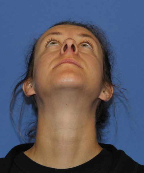 Rhinoplasty 1266 – Click HERE for more views before photo. Individual results may vary.