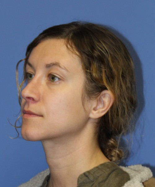 Rhinoplasty 1266 – Click HERE for more views after photo. Individual results may vary.