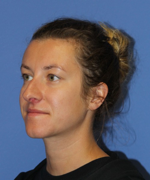 Rhinoplasty 1266 – Click HERE for more views before photo. Individual results may vary.