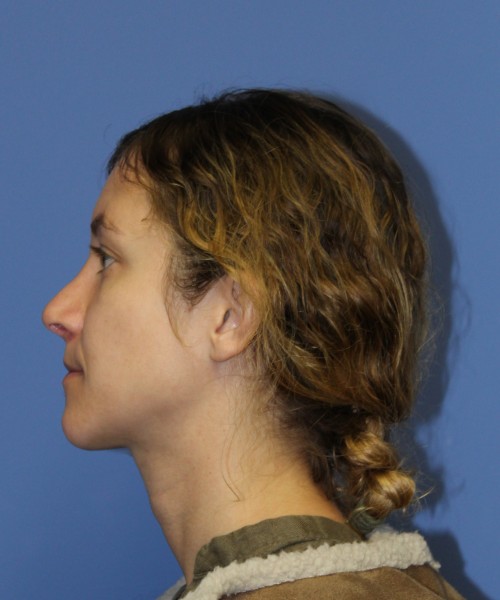 Rhinoplasty 1266 – Click HERE for more views after photo. Individual results may vary.