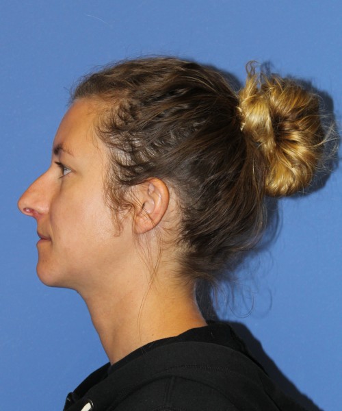 Rhinoplasty 1266 – Click HERE for more views before photo. Individual results may vary.