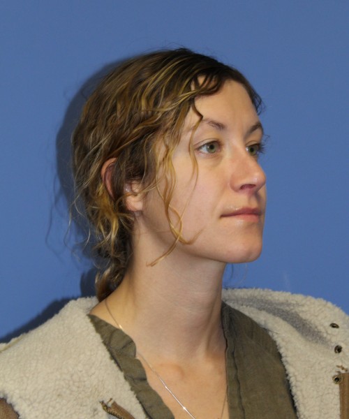 Rhinoplasty 1266 – Click HERE for more views after photo. Individual results may vary.