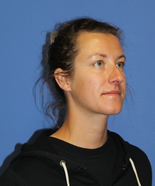 Rhinoplasty 1266 – Click HERE for more views before photo. Individual results may vary.