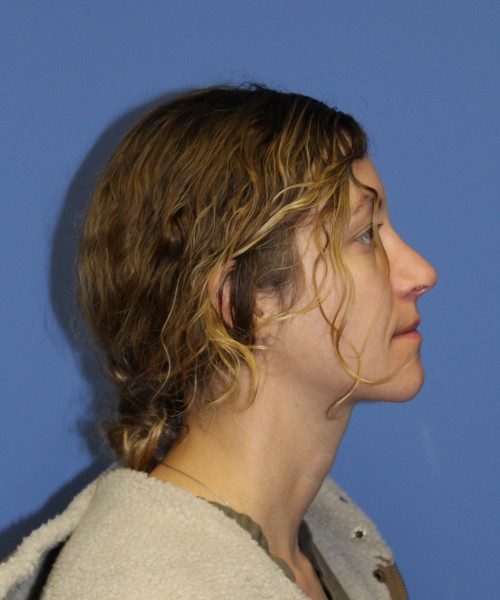 Rhinoplasty 1266 – Click HERE for more views after photo. Individual results may vary.
