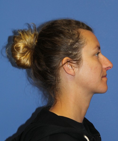 Rhinoplasty 1266 – Click HERE for more views before photo. Individual results may vary.