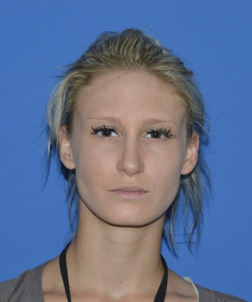Rhinoplasty 1267 – Click HERE for more views after photo. Individual results may vary.
