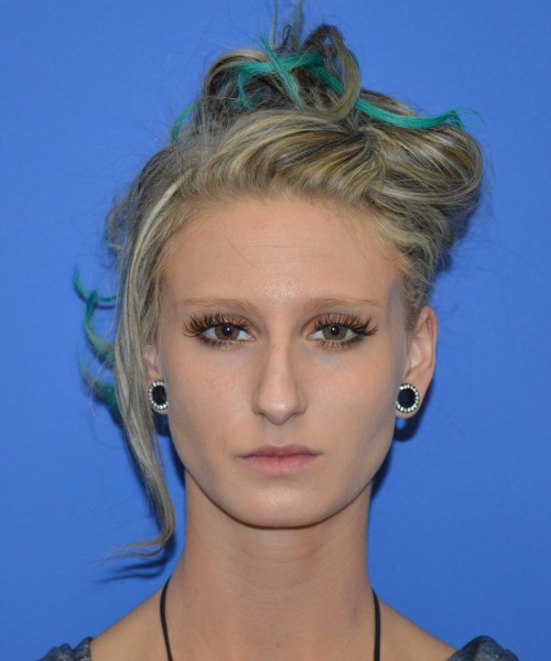 Rhinoplasty 1267 – Click HERE for more views before photo. Individual results may vary.