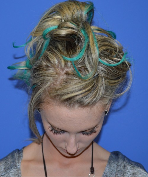 Rhinoplasty 1267 – Click HERE for more views before photo. Individual results may vary.