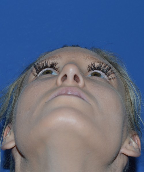 Rhinoplasty 1267 – Click HERE for more views after photo. Individual results may vary.