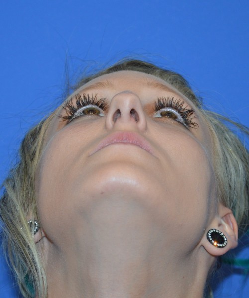 Rhinoplasty 1267 – Click HERE for more views before photo. Individual results may vary.