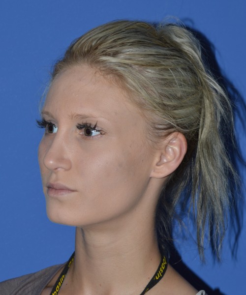 Rhinoplasty 1267 – Click HERE for more views after photo. Individual results may vary.