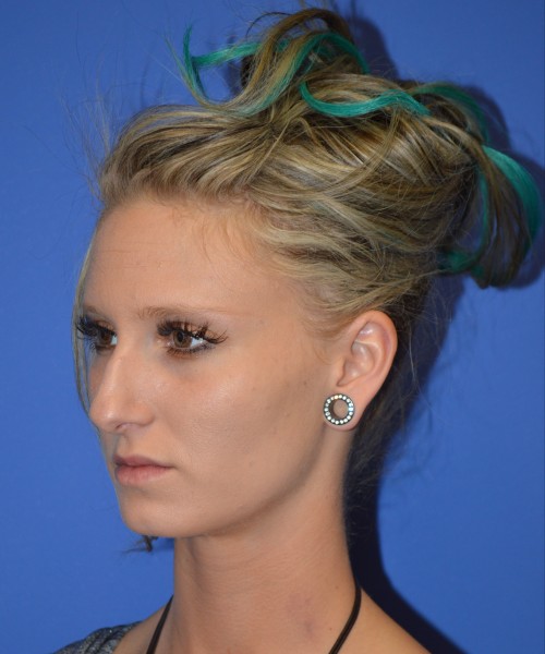 Rhinoplasty 1267 – Click HERE for more views before photo. Individual results may vary.