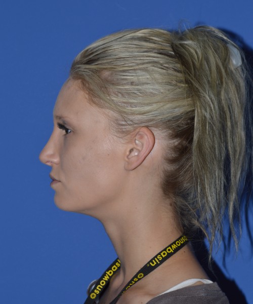 Rhinoplasty 1267 – Click HERE for more views after photo. Individual results may vary.