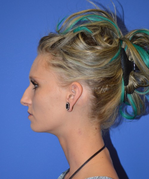 Rhinoplasty 1267 – Click HERE for more views before photo. Individual results may vary.